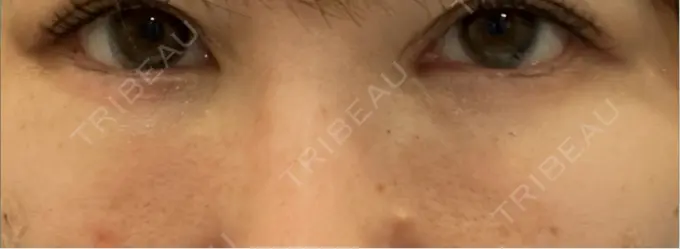 脂肪注入（目の下） Mare beauty clinic DAY 13 メイン用