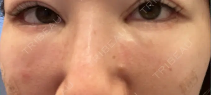 脂肪注入（目の下） Mare beauty clinic DAY 12 メイン用