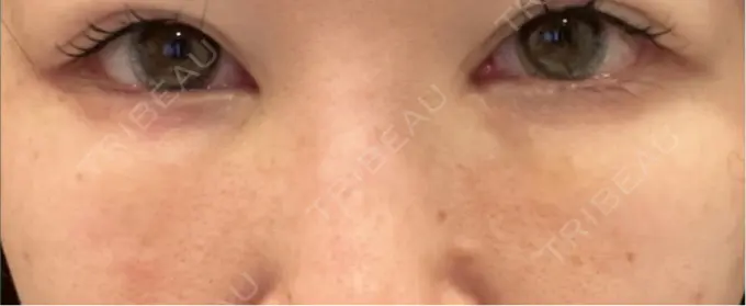 脂肪注入（目の下） Mare beauty clinic DAY 16 メイン用