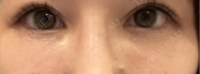 脂肪注入（目の下） Mare beauty clinic DAY 17 メイン用