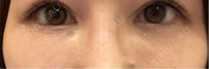 脂肪注入（目の下） Mare beauty clinic DAY 24 メイン用
