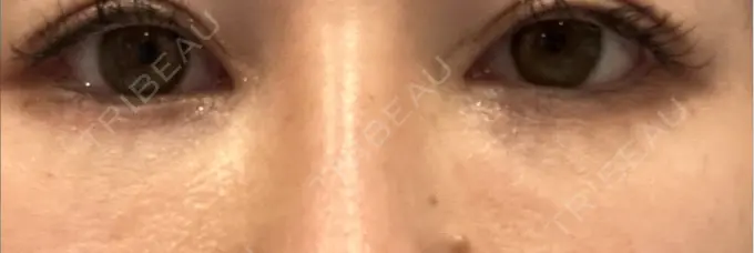 脂肪注入（目の下） Mare beauty clinic DAY 58 メイン用