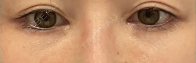 脂肪注入（目の下） Mare beauty clinic AFTER メイン用
