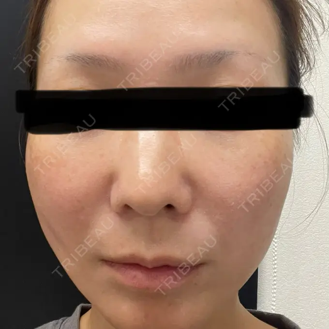 糸リフト / クマ治療 / 肌ヒアルロン酸注入（たるみ・シワ改善） ルラ美容クリニック 静岡院 AFTER メイン用