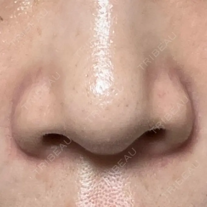 その他（鼻） LE CLINIC AFTER メイン用