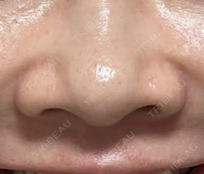 その他（鼻） LE CLINIC DAY 42 メイン用