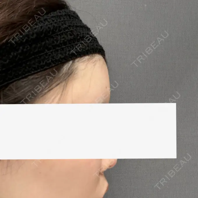 脂肪注入（額） / ヒアルロン酸溶解 ルーチェクリニック 銀座院 AFTER メイン用