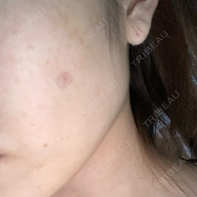 ほくろ・いぼ除去レーザー（肌） 明治通りクリニック DAY 3 メイン用