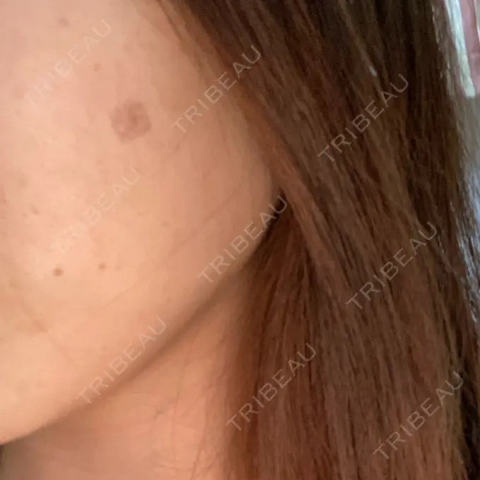 ほくろ・いぼ除去レーザー（肌） 明治通りクリニック DAY 4 メイン用