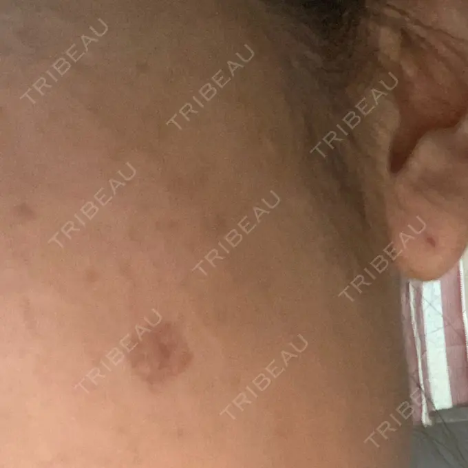 ほくろ・いぼ除去レーザー（肌） 明治通りクリニック DAY 5 メイン用