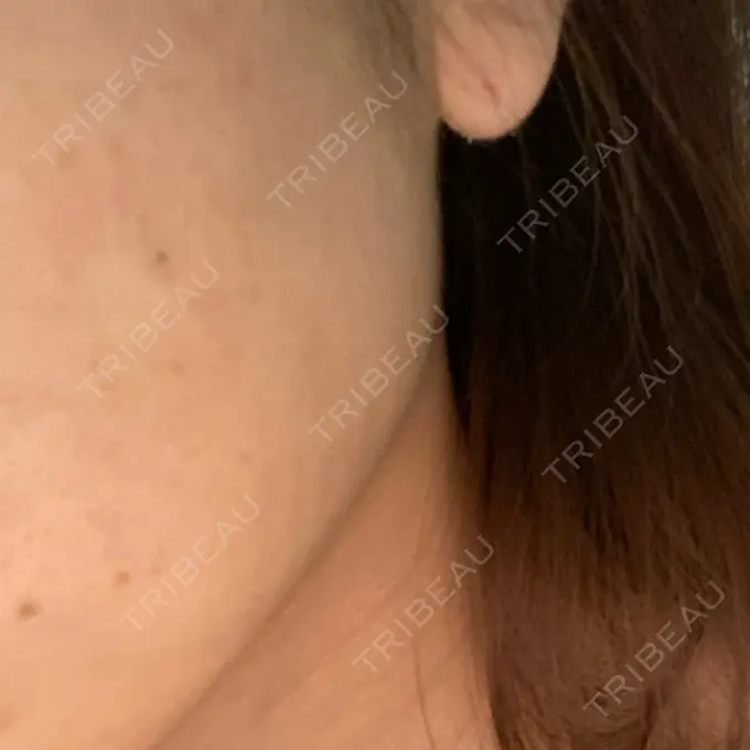 ほくろ・いぼ除去レーザー（肌） 明治通りクリニック DAY 6 メイン用