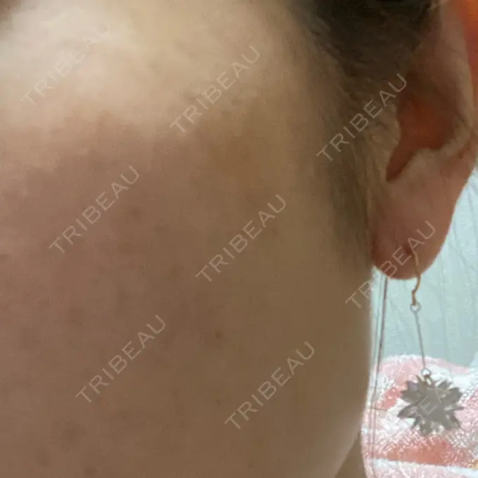 ほくろ・いぼ除去レーザー（肌） 明治通りクリニック DAY 7 メイン用