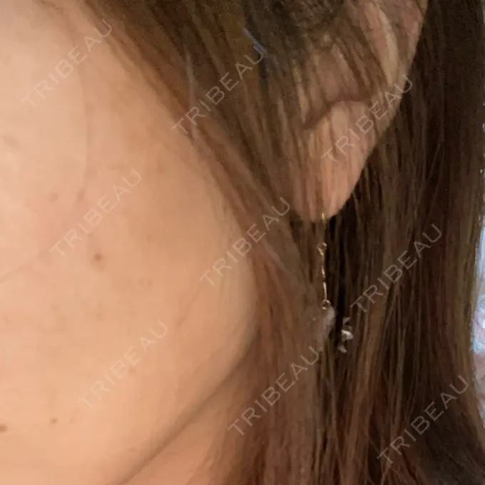 ほくろ・いぼ除去レーザー（肌） 明治通りクリニック DAY 8 メイン用