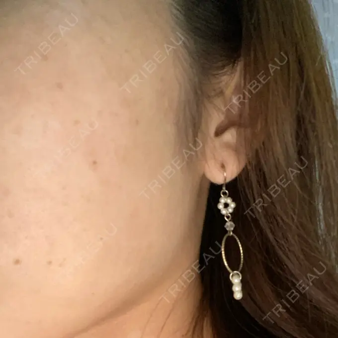 ほくろ・いぼ除去レーザー（肌） 明治通りクリニック DAY 10 メイン用