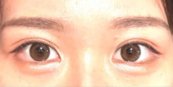 二重埋没 THE FIRST CLINIC 多摩センター院 DAY 31 メイン用