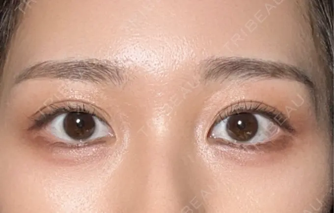 二重埋没 THE FIRST CLINIC 多摩センター院 AFTER メイン用