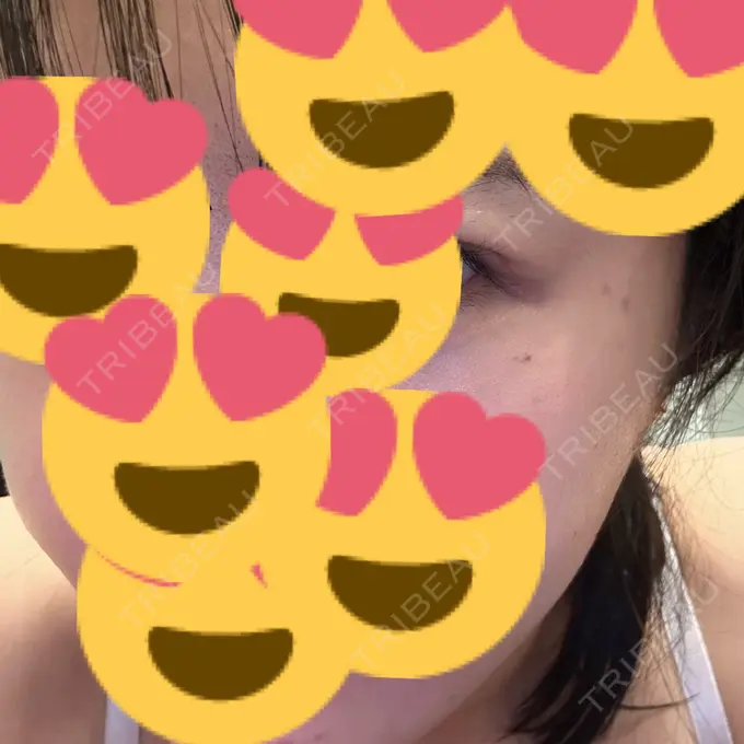 糸リフト / 脂肪吸引（顔） / 脂肪吸引（二の腕） / 上まぶたたるみ取り / 上まぶたの脂肪取り / ジョールファット除去 / 脂肪吸引（肩） / ボトックス（エラ・小顔） 湘南美容クリニック 秋葉原院 DAY 119 メイン用