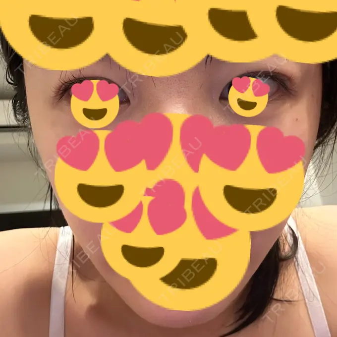 糸リフト / 脂肪吸引（顔） / 脂肪吸引（二の腕） / 上まぶたたるみ取り / 上まぶたの脂肪取り / ジョールファット除去 / 脂肪吸引（肩） / ボトックス（エラ・小顔） 湘南美容クリニック 秋葉原院 DAY 119 メイン用