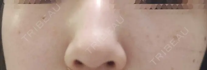 ピーリング（ハリ・ツヤ） / ルメッカ ルラ美容クリニック 仙台院 / ルラスキンクリニック 仙台院 DAY 5 メイン用