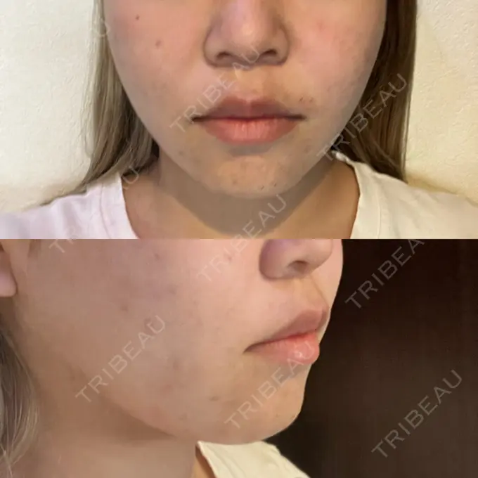 糸リフト 東京シンデレラ美容外科 池袋院 AFTER メイン用