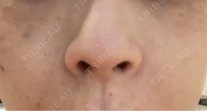 その他（肌） 美容皮膚科エルムクリニック 岡山院 DAY 3 メイン用