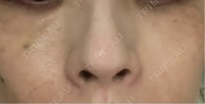 その他（肌） 美容皮膚科エルムクリニック 岡山院 DAY 4 メイン用