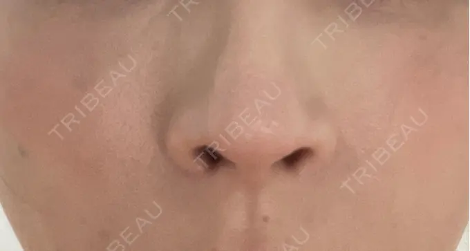 その他（肌） 美容皮膚科エルムクリニック 岡山院 DAY 5 メイン用