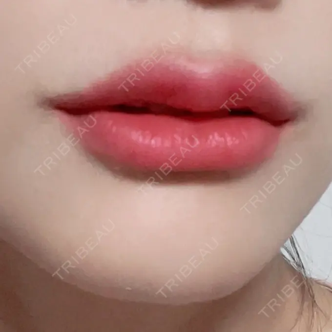 ヒアルロン酸注入（唇） R Beauty CLINIC 銀座院 AFTER メイン用