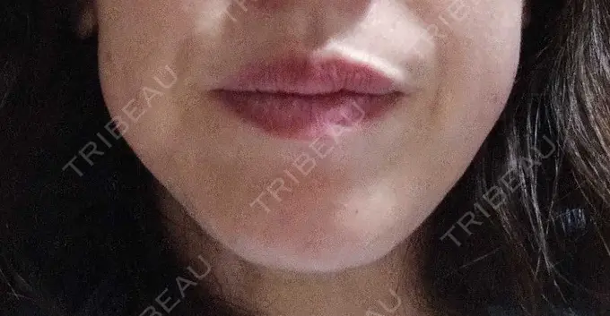 ボトックス（エラ・小顔） TCB東京中央美容外科 金山院 AFTER メイン用