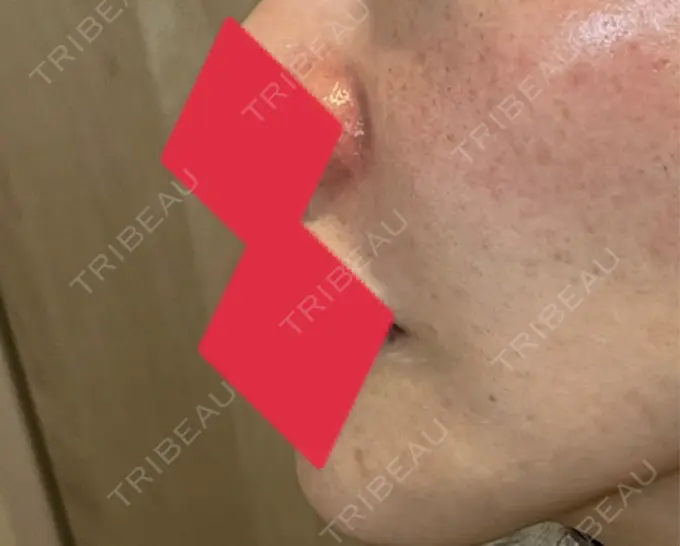 ヒアルロン酸注入（鼻翼基部） AYANAフィラーズクリニック 渋谷院 DAY 46 メイン用