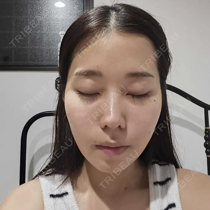 糸リフト / 脂肪吸引（顔） / ボトックス（エラ・小顔） RIVER CLINIC（リバークリニック） DAY 14 メイン用