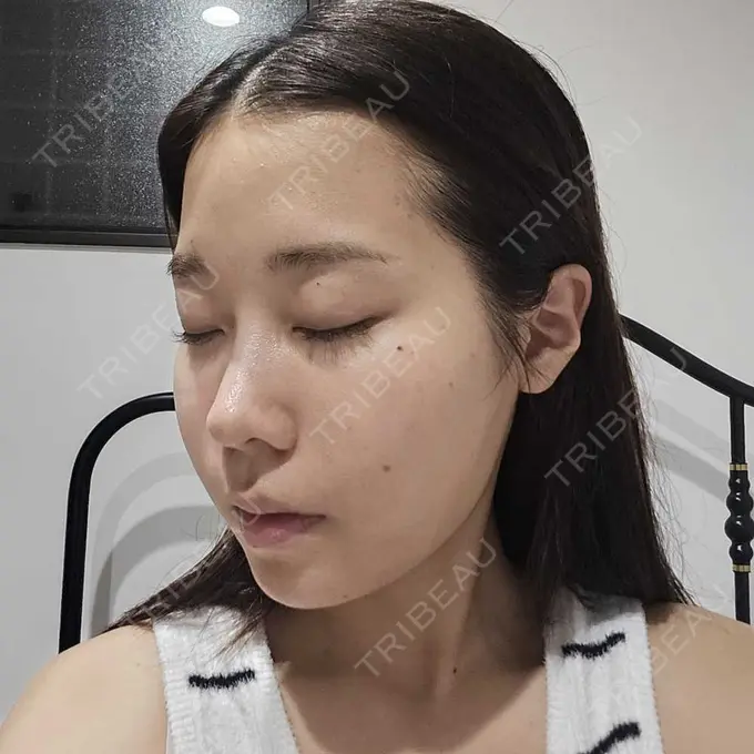 糸リフト / 脂肪吸引（顔） / ボトックス（エラ・小顔） RIVER CLINIC（リバークリニック） DAY 14 メイン用