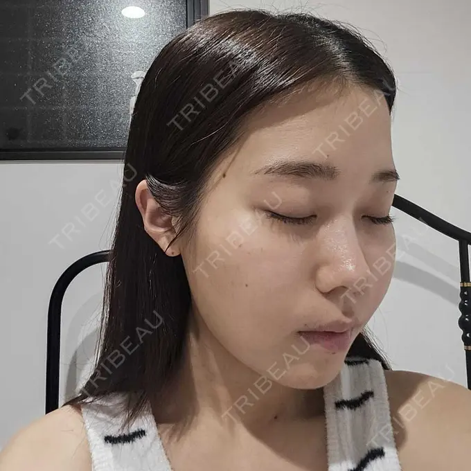 糸リフト / 脂肪吸引（顔） / ボトックス（エラ・小顔） RIVER CLINIC（リバークリニック） DAY 14 メイン用