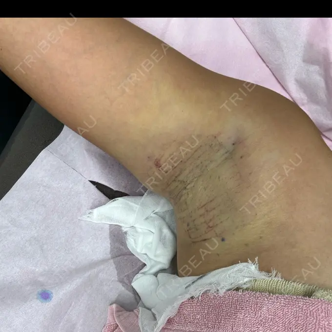 ワキ汗治療（レーザー） ルラ美容クリニック 渋谷本院 AFTER メイン用