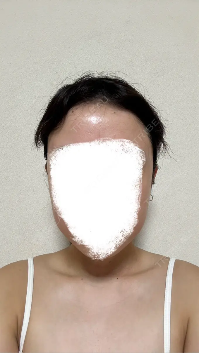 ボトックス（エラ・小顔） / ボトックス（肩） / ボトックス（眉間） / ボトックス（額） TCB東京中央美容外科 新宿東口院 AFTER メイン用