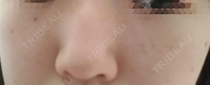 ピーリング（ハリ・ツヤ） / ルメッカ ルラ美容クリニック 仙台院 / ルラスキンクリニック 仙台院 DAY 7 メイン用