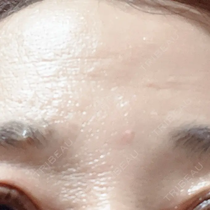 水光注射（ハリ・美肌） / ボトックス（額） 品川美容外科 名古屋院 DAY 0 メイン用