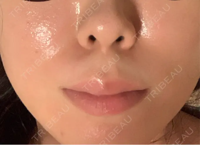 レーザーフェイシャル LIGHT CLINIC 【ライトクリニック】 新宿院 AFTER メイン用