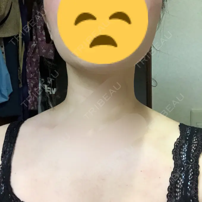 ボトックス（肩） リエンジャン整形外科 江南店 AFTER メイン用