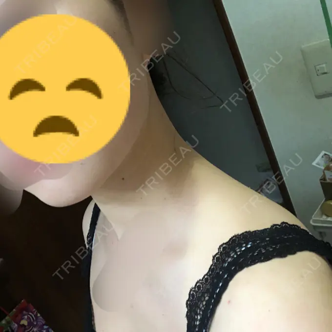 ボトックス（肩） リエンジャン整形外科 江南店 DAY 10 メイン用