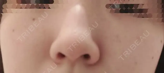 ピーリング（ハリ・ツヤ） / ルメッカ ルラ美容クリニック 仙台院 / ルラスキンクリニック 仙台院 DAY 8 メイン用