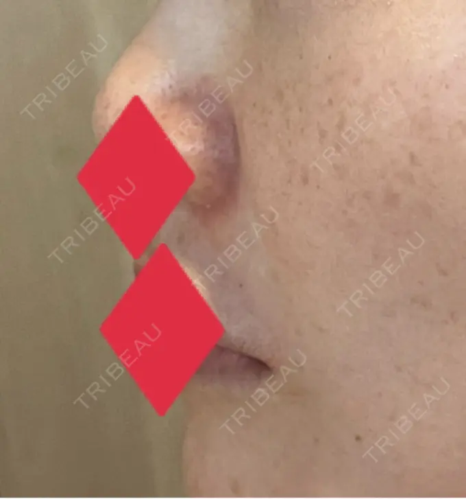 ヒアルロン酸注入（鼻翼基部） AYANAフィラーズクリニック 渋谷院 DAY 40 メイン用