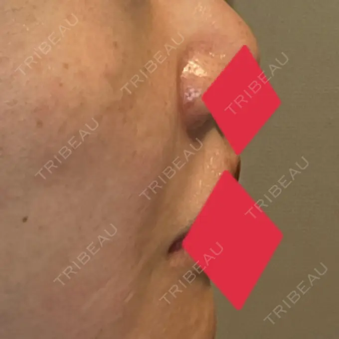 ヒアルロン酸注入（鼻翼基部） AYANAフィラーズクリニック 渋谷院 DAY 40 メイン用