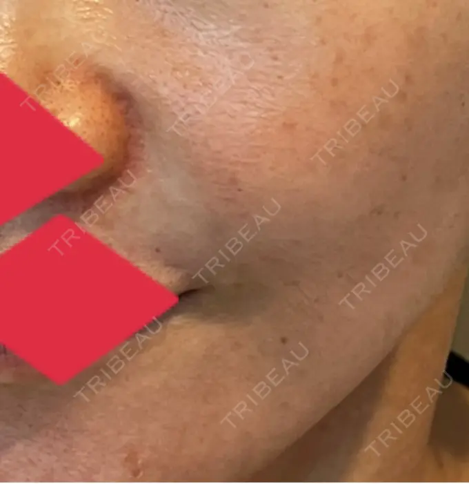 ヒアルロン酸注入（鼻翼基部） AYANAフィラーズクリニック 渋谷院 DAY 43 メイン用