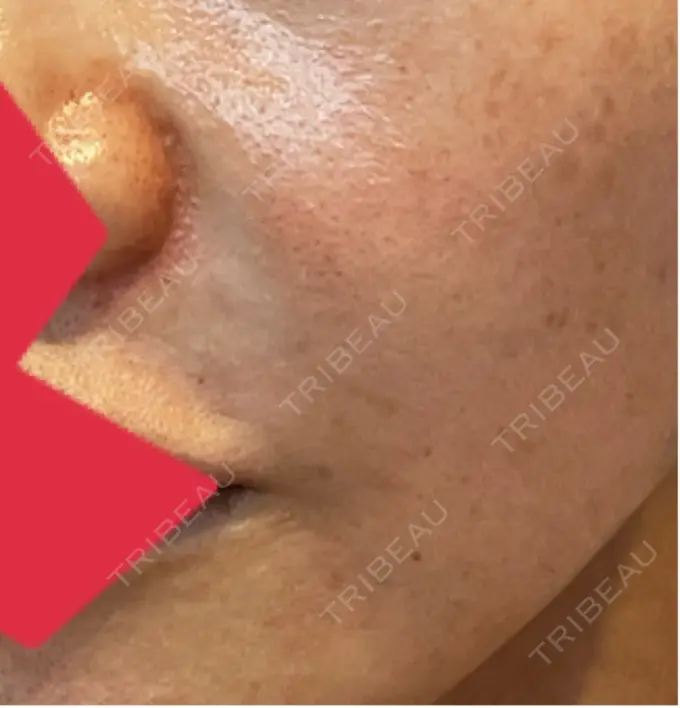 ヒアルロン酸注入（鼻翼基部） AYANAフィラーズクリニック 渋谷院 DAY 45 メイン用