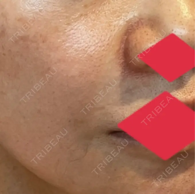 ヒアルロン酸注入（鼻翼基部） AYANAフィラーズクリニック 渋谷院 DAY 45 メイン用