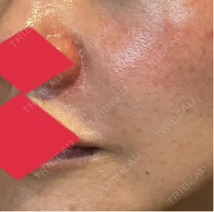 ヒアルロン酸注入（鼻翼基部） AYANAフィラーズクリニック 渋谷院 AFTER メイン用