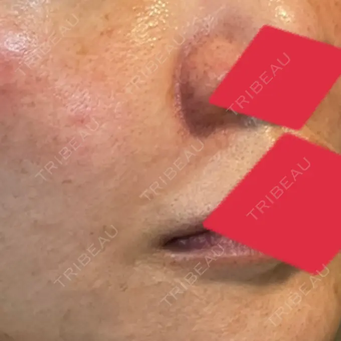 ヒアルロン酸注入（鼻翼基部） AYANAフィラーズクリニック 渋谷院 DAY 47 メイン用