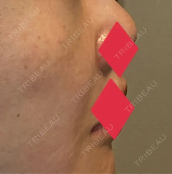 ヒアルロン酸注入（鼻翼基部） AYANAフィラーズクリニック 渋谷院 DAY 46 メイン用