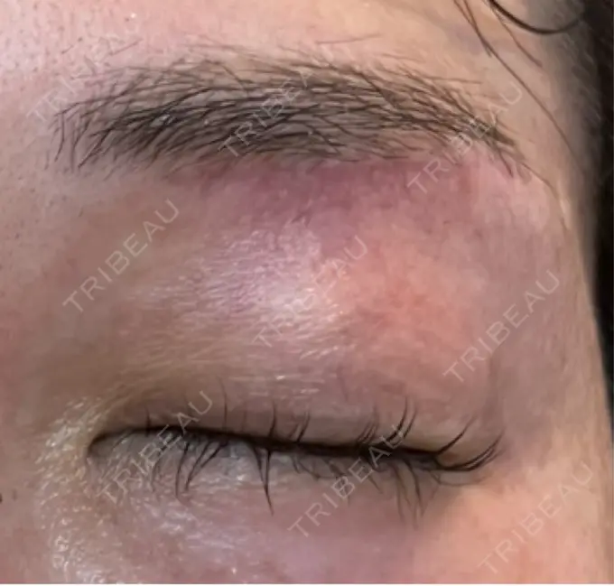 上まぶたの脂肪取り / 眉下切開 / ボトックス（眉間） THE FIRST CLINIC 多摩センター院 DAY 201 メイン用